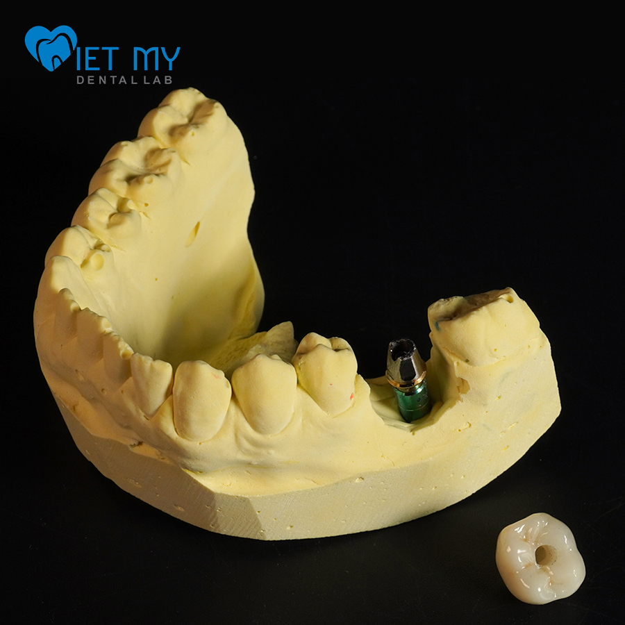Chụp Răng Trên Implant