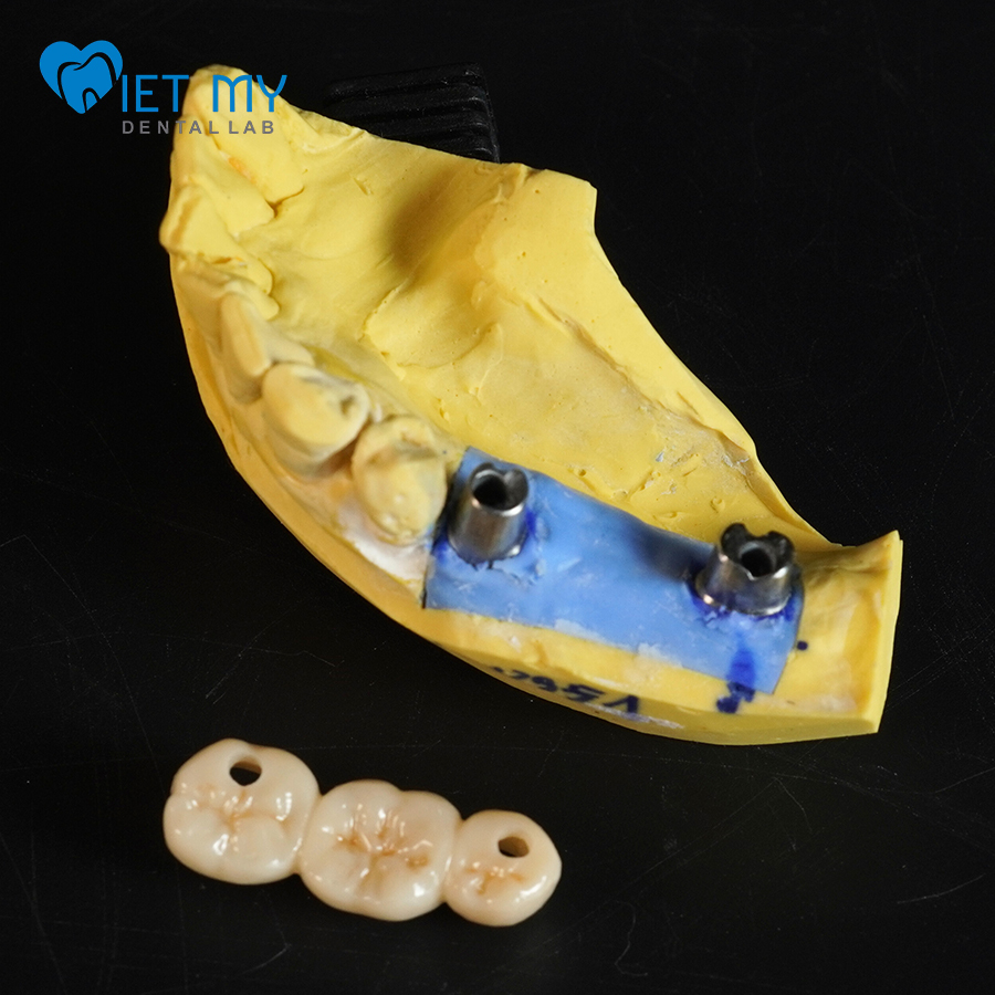 Cầu Răng Trên Implant
