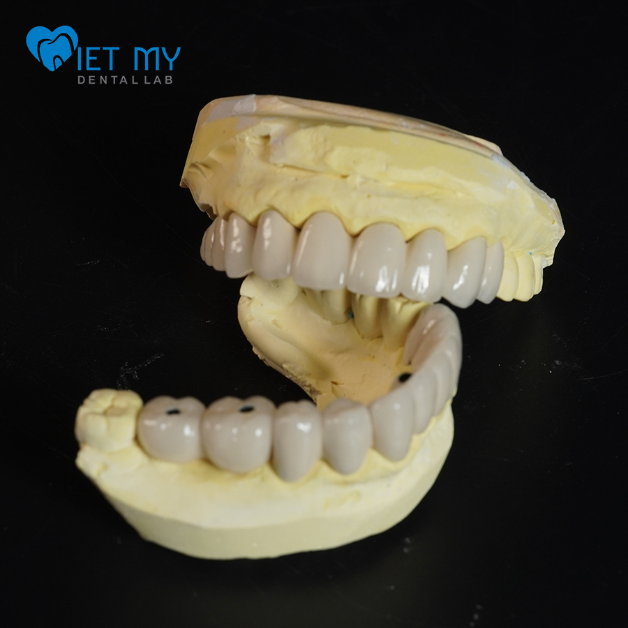 Phục Hình Răng Sứ Kim Loại