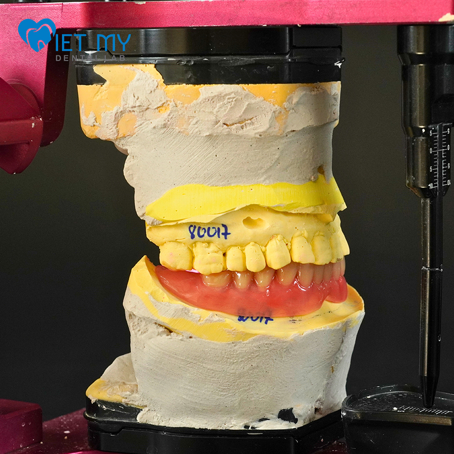 Tháo Lắp Trên Implant